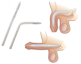 The Genesis™ Flexible Rod Penile Implant
