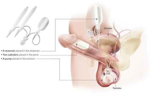 The Titan Touch® Inflatable Penile Implant